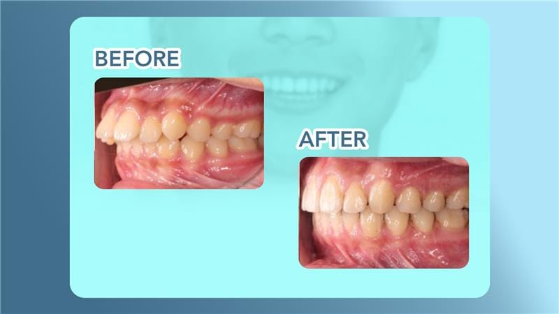 Here are before and after results of how braces fixed overjet issues of our patients in Bellevue.
