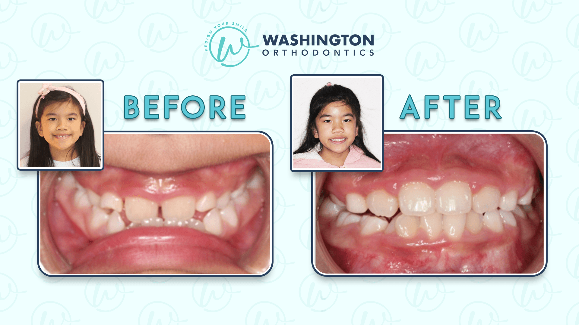 Before and after results of Phase 1 treatment