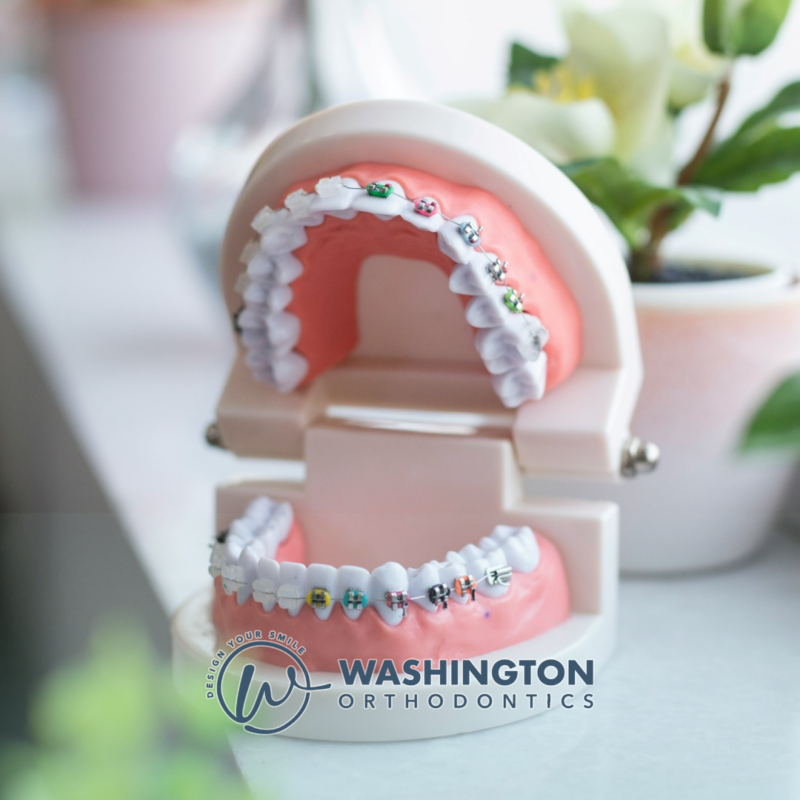 Learn orthodontists consultation costs in Factoria, Bellevue, and Washington State