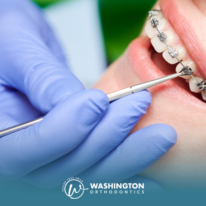 Learn how much braces cost in Bellevue and nearby areas