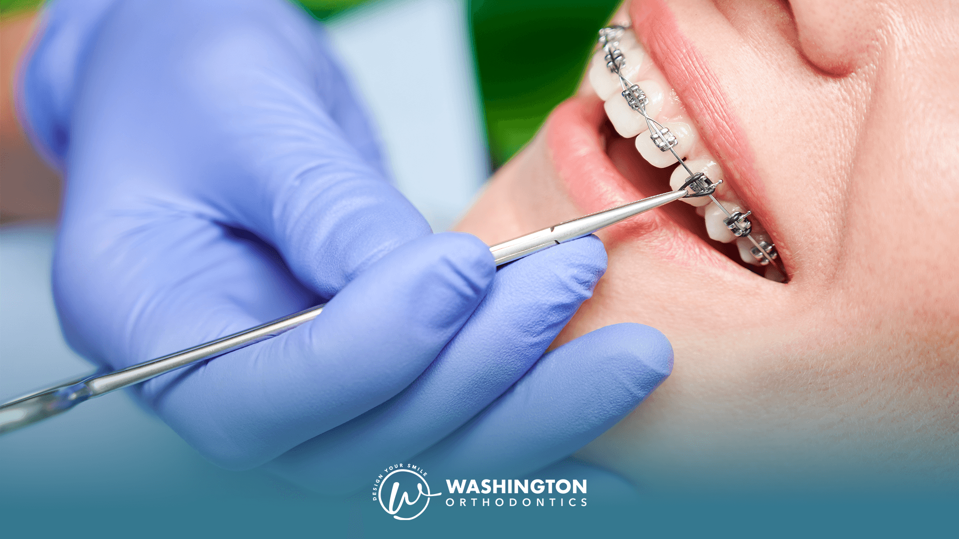 Learn how much braces cost in Bellevue and nearby areas