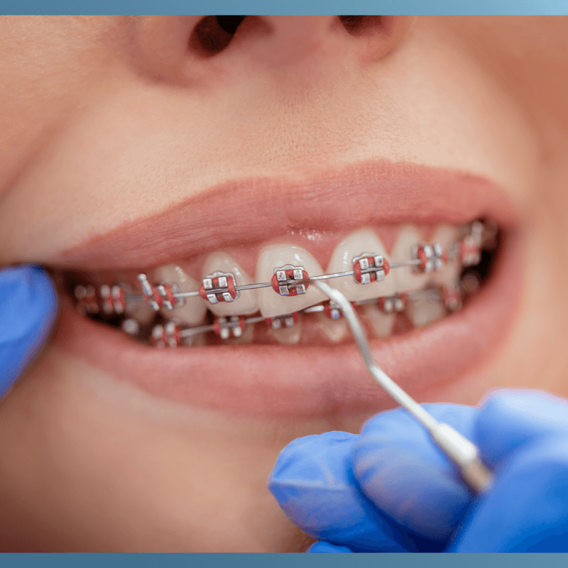 Here is what you would expect when it comes to braces insurance coverage in Washington