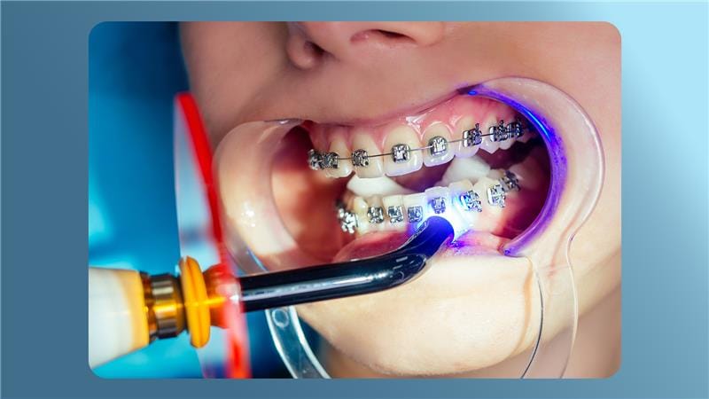 How long do braces take to work