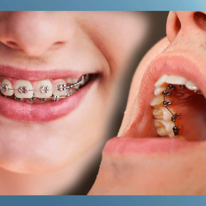 Braces vs Lingual Braces