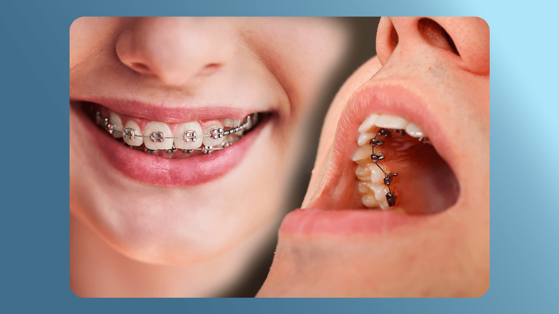 Braces vs Lingual Braces