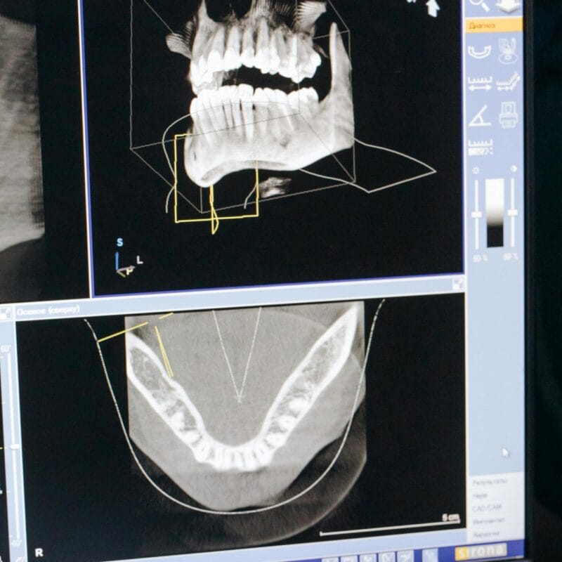 can braces fix jaw alignment