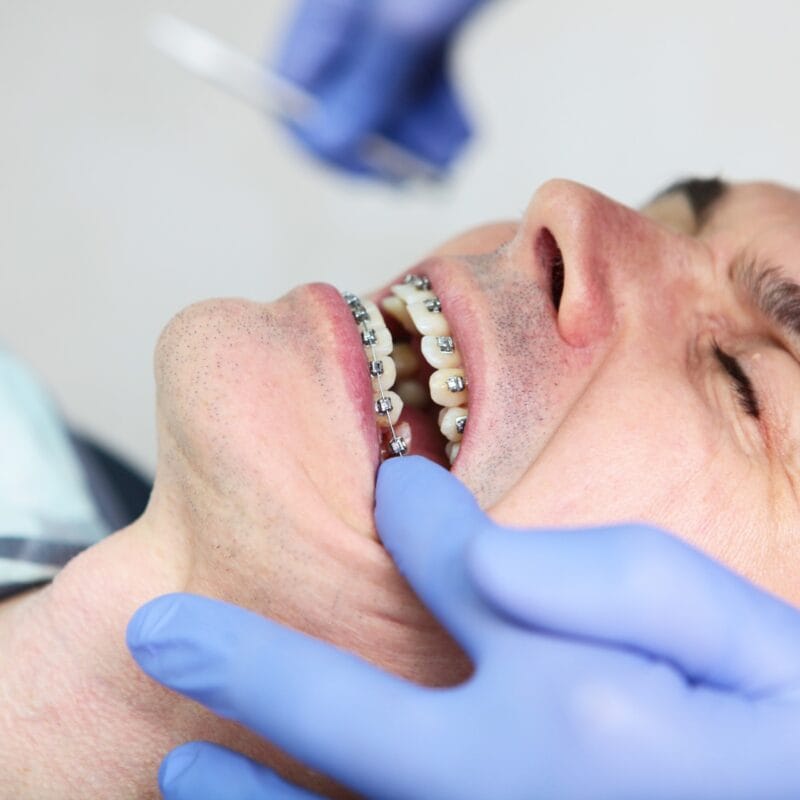 Dental Brace with Bone Loss