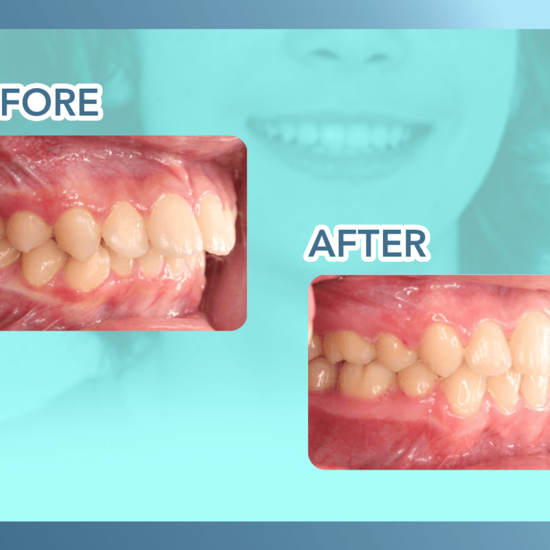 Overjet before and after