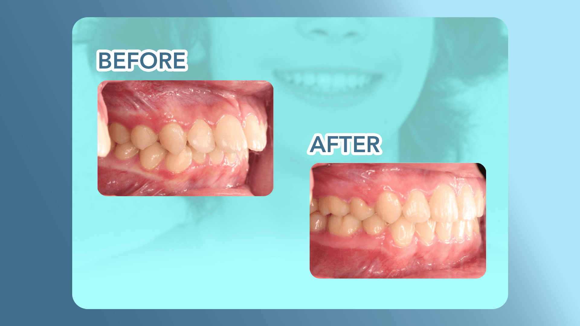 Overjet before and after