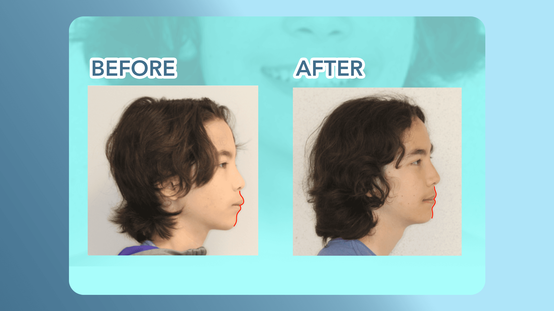 Here’s a look at the side profile before and after overjet correction with braces.